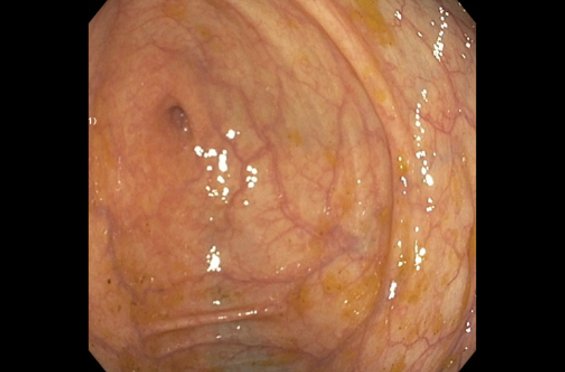 Colonoscopy frame of the cecum